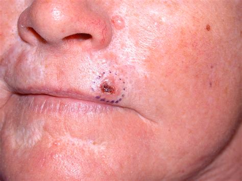 In normal skin, the basal cells are less than one one-hundredth of an inch deep, but once a cancer has developed. . Basal cell carcinoma untreated for 10 years
